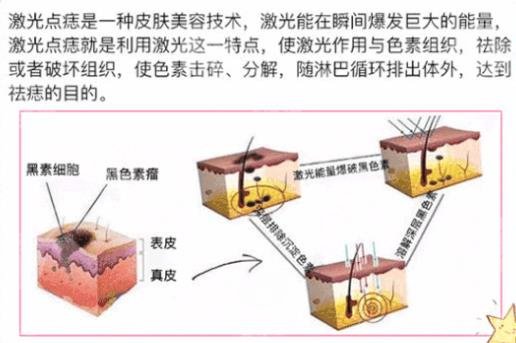 激光点痣多少钱一颗？有3个价格影响因素！