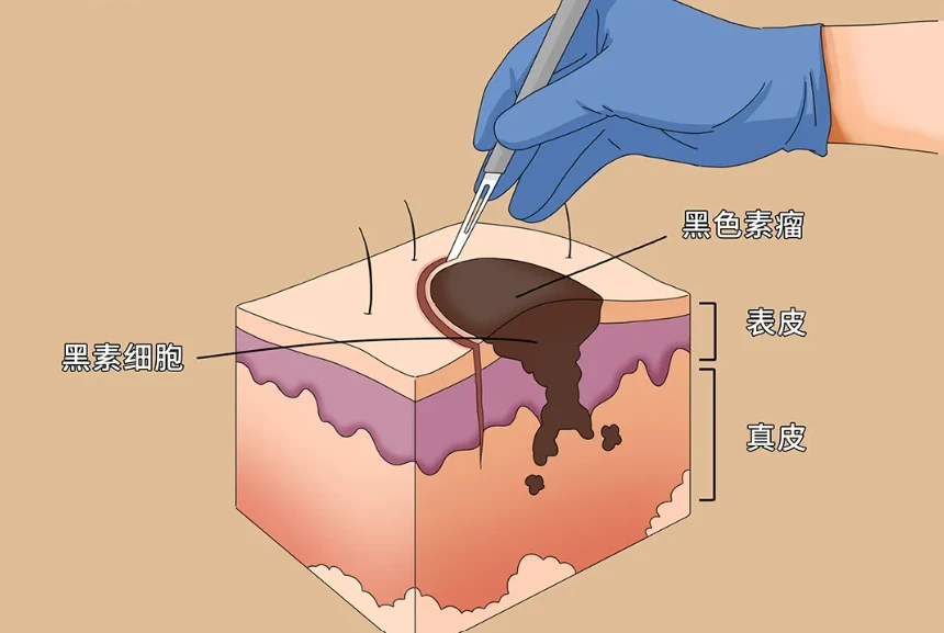 如何点痣_点痣老方法_点痣方式