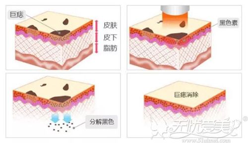 最新方法点痣图片_最新方法点痣视频教程_最新点痣方法