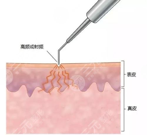 点点痣完多久可以洗脸_点点痣后多久可以洗脸_点痣什么点